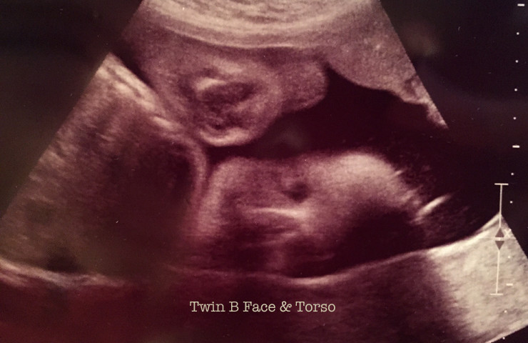 Mono/Di Identical Twins-Twin B at www.saras-house.com